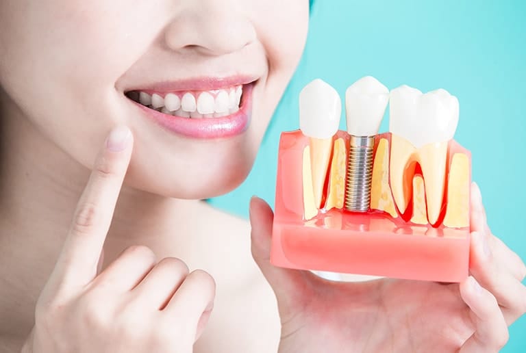 Periodontal Treatment Dental Implants