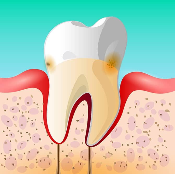 Slight Periodontal Disease