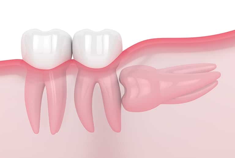 Tooth Extraction Wisdom Teeth