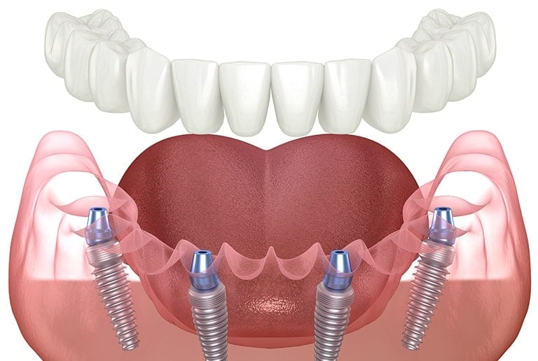 All On 4 Dental Implants Surgery
