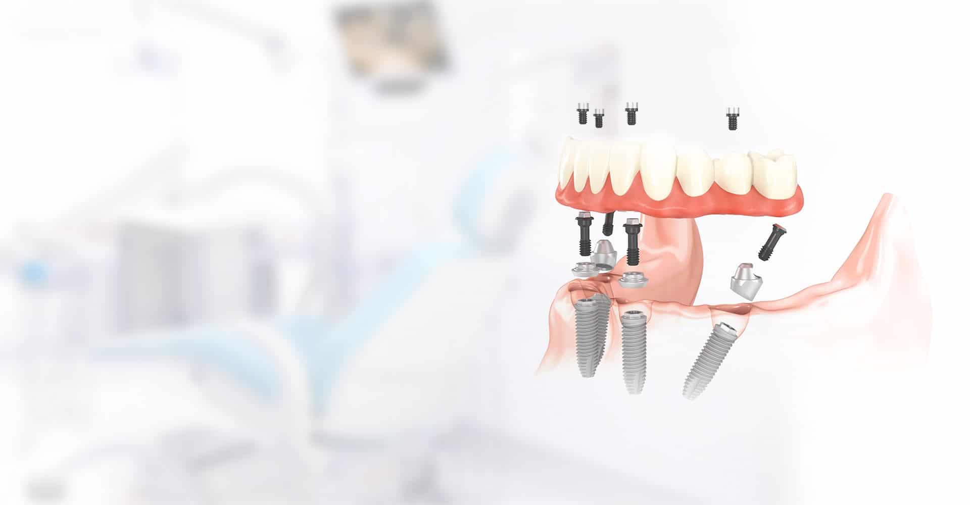 All On Four Dental Implants