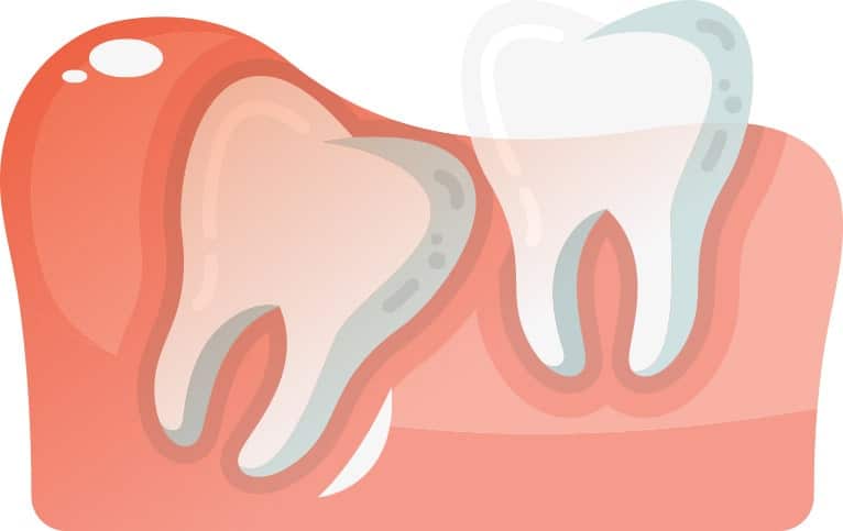 Angularly Aligned Wisdom Tooth