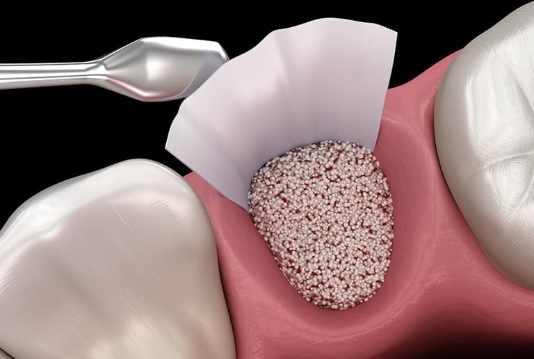 Bone Grafting Surgery