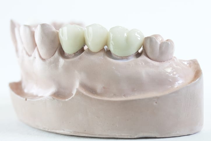 Dental Bridge