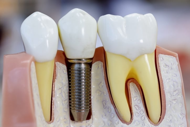 Close Up Of Dental Model With Implantation