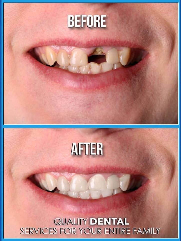 Dental implants pictures before and after