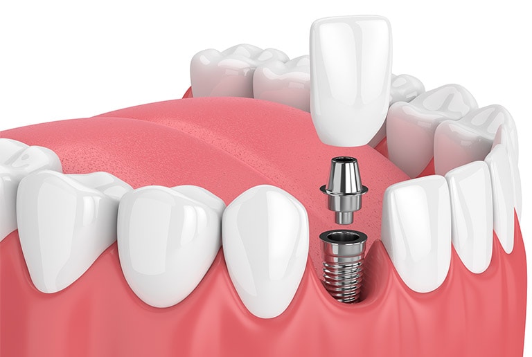 Dental Implants Surgery