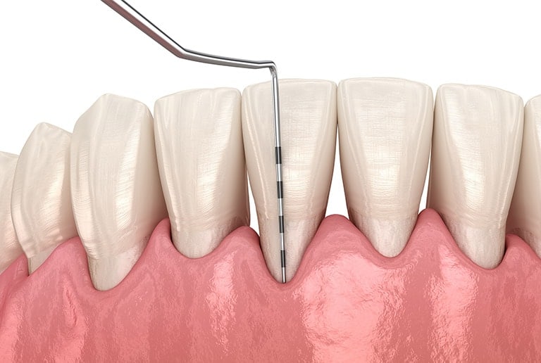 Gingival Graft Toronto