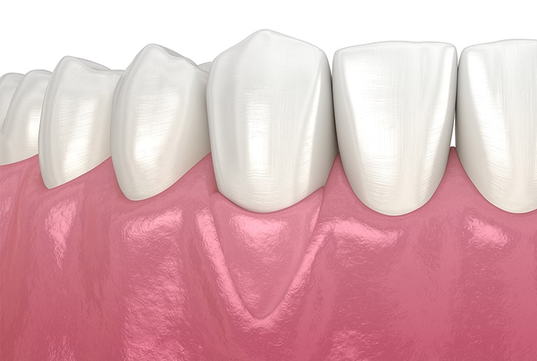 Gum Graft Recovery Toronto