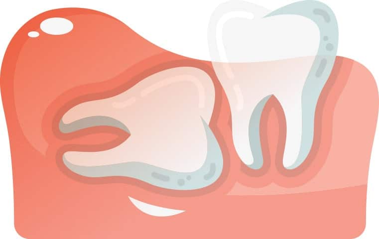 Horizontally Aligned Wisdom Tooth