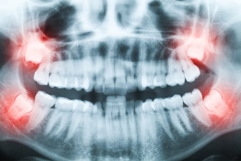 Impacted Wisdom Teeth