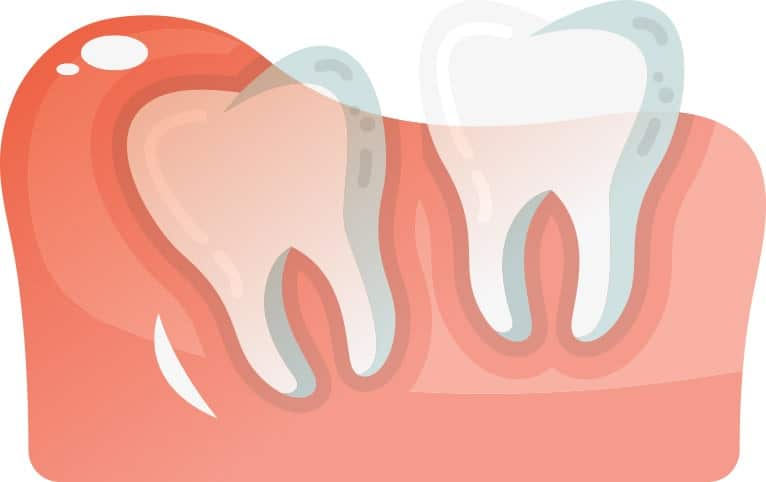 Partially Erupted Wisdom Tooth