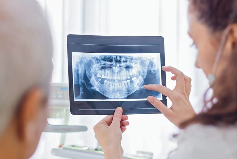 Periodontal Disease Loose Teeth