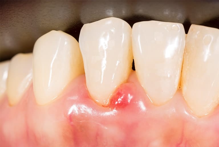 Periodontal Disease Pus Around