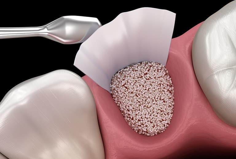 Periodontal Treatment Bone Grafts