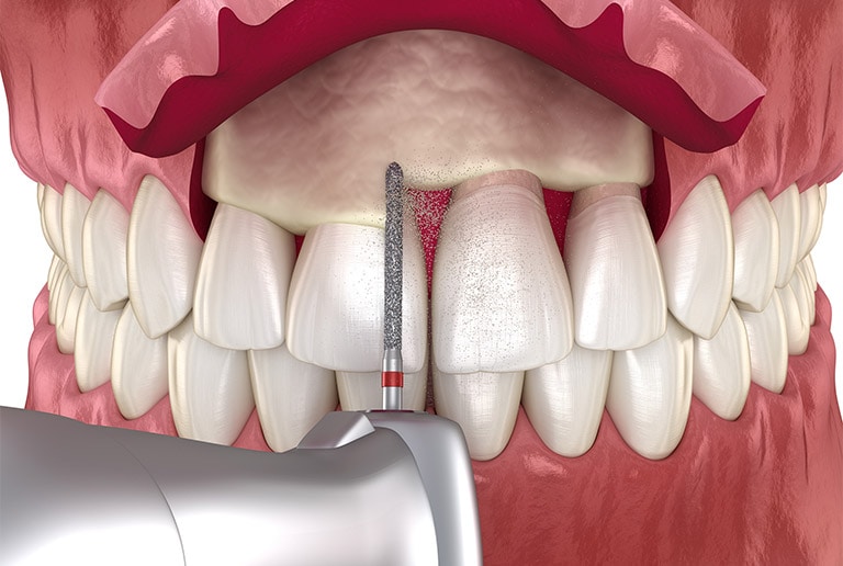 Periodontal Treatment Crown Lengthening