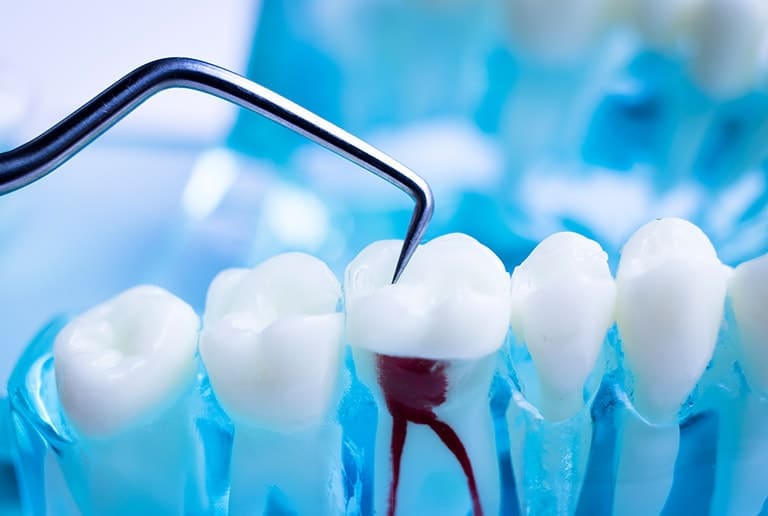 Root Canals Surgery