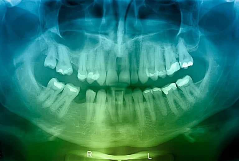 Teeth Cleaning Dental X Rays