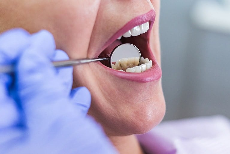 Teeth Cleaning Oral Cancer Screening in Toronto