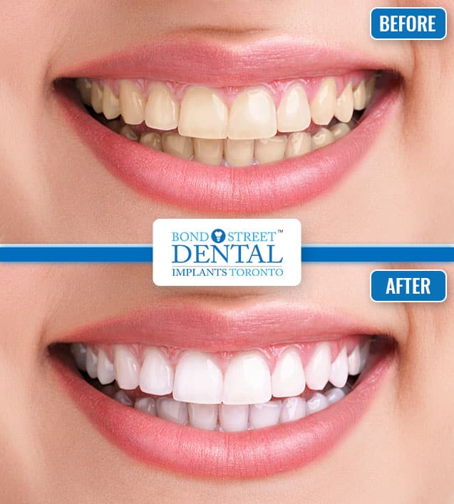 Teeth Whitening Before and After 1