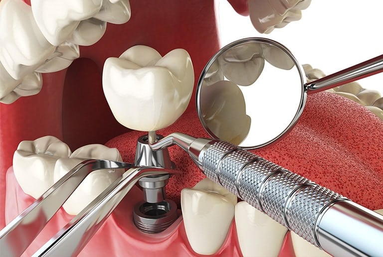 Tooth Extraction For Dental Implants