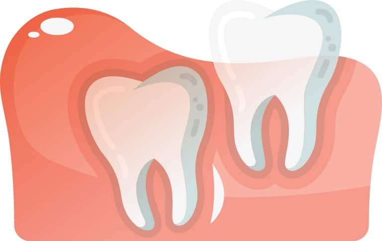 Vertically Aligned Wisdom Tooth