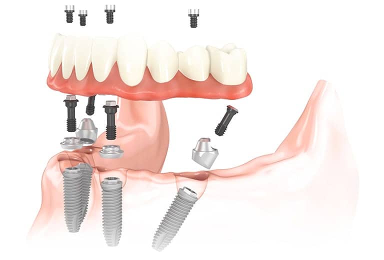 All On 4 Dental Implants Toronto