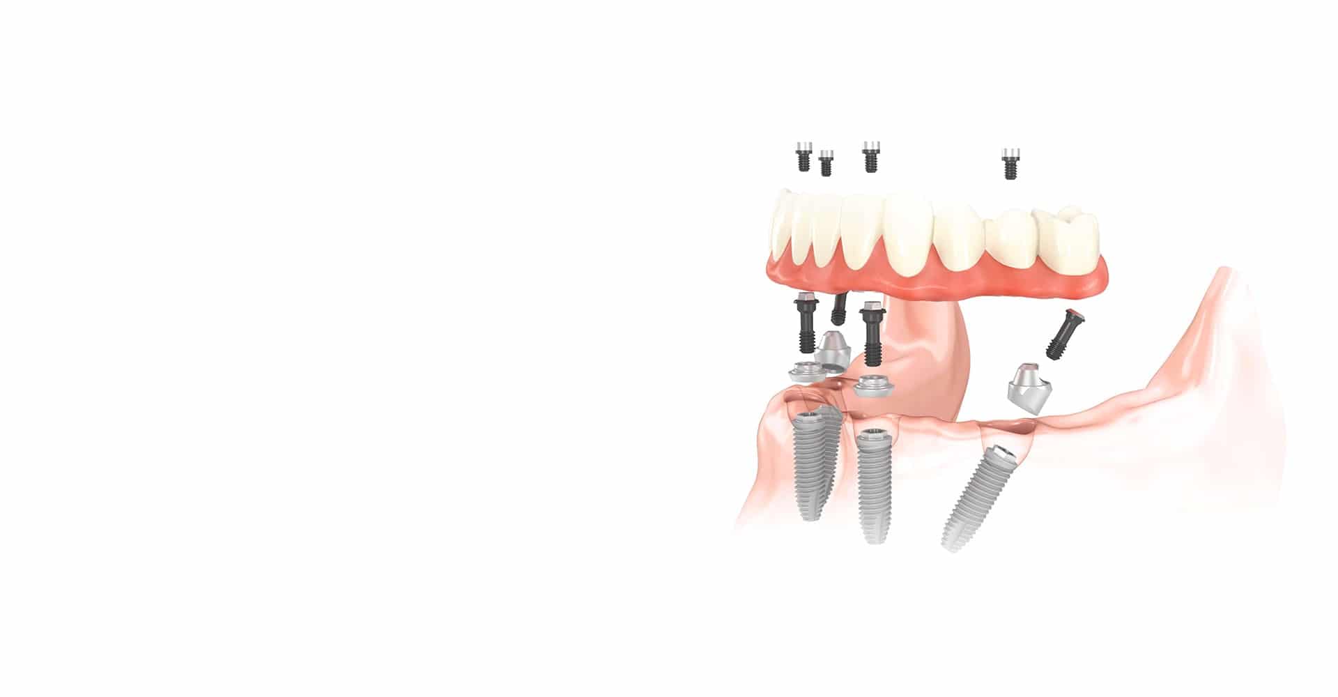 All On 4 Dental Implants Toronto