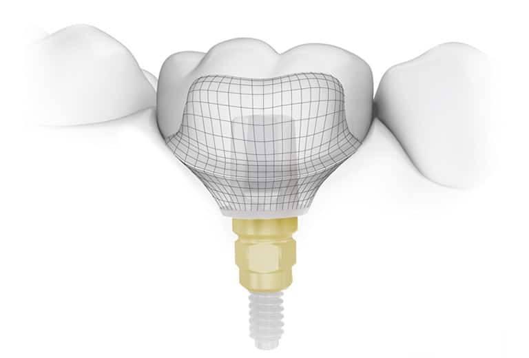 Cutting Edge Dental Implant Technology Toronto