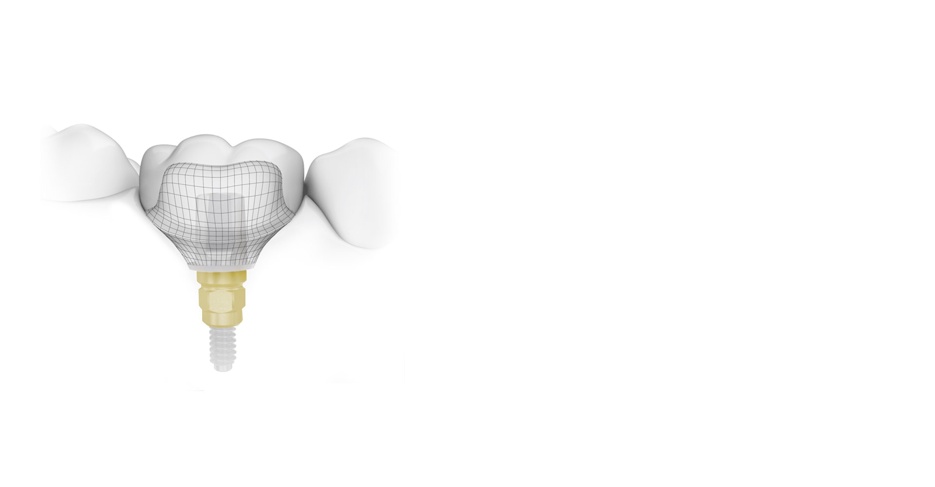 Cutting Edge Dental Implant Technology Toronto