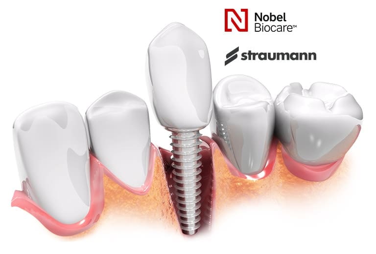 Premium Quality Dental Implants Toronto