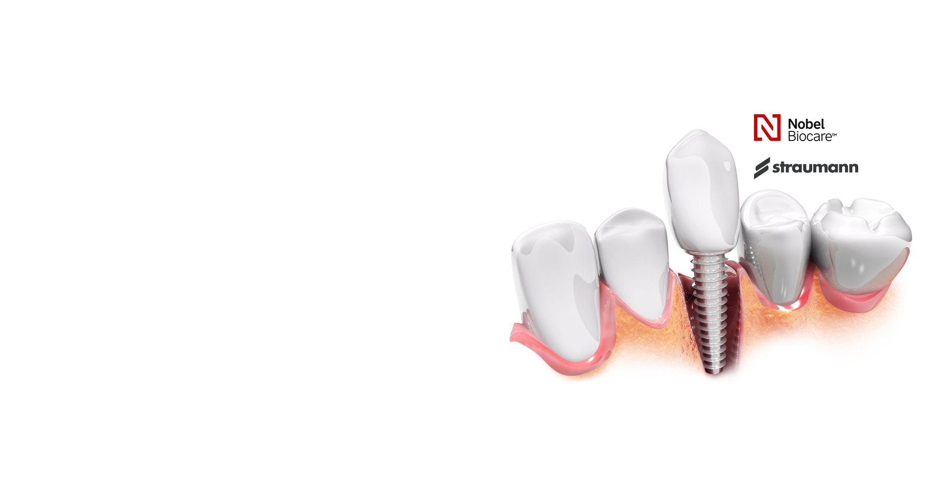 Premium Quality Dental Implants Toronto