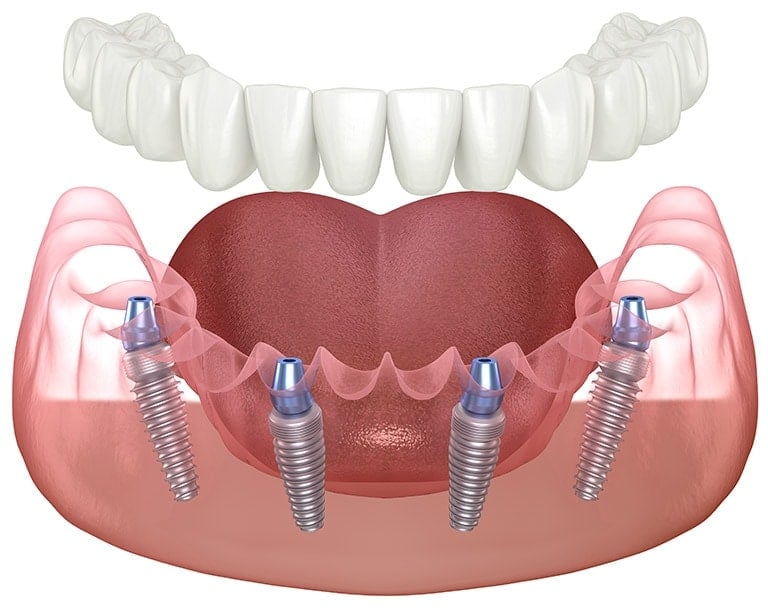 All on 4 Dental Implants Toronto