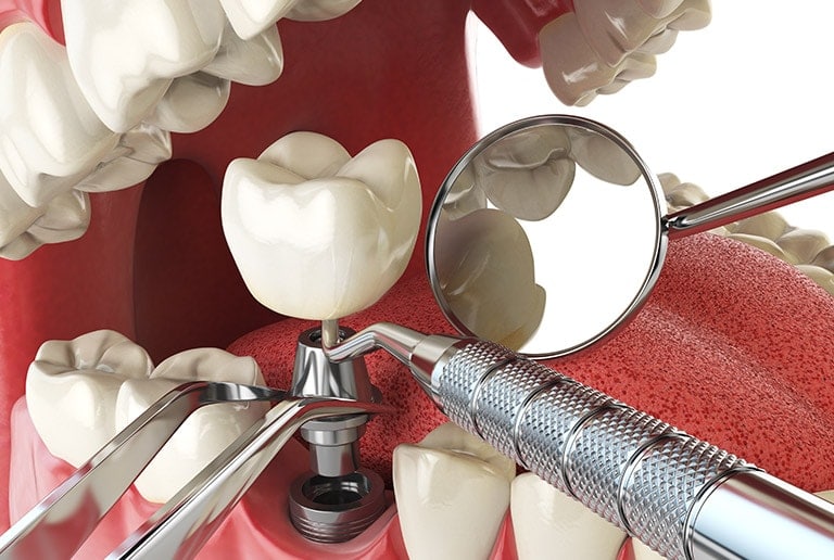 Dental Implant Procedures Toronto