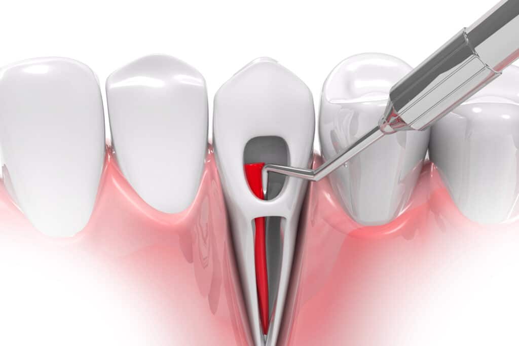 What is a Root Canal?