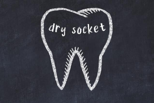 6 Tips for How To Treat A Dry Socket