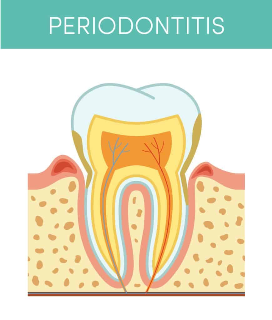Chronic periodontitis