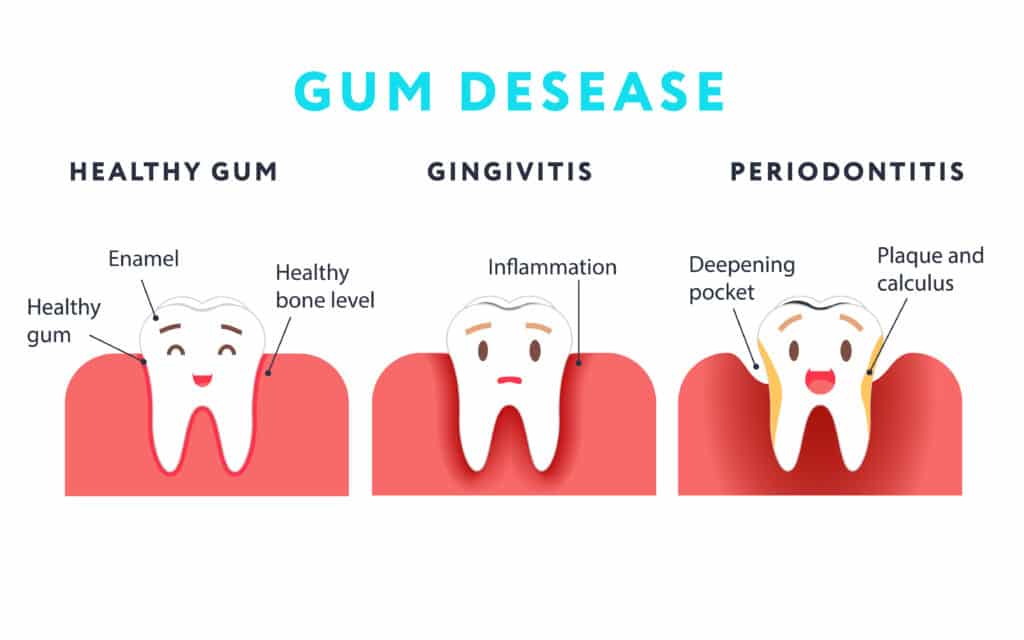 Gum disease can reduce your ability to fight off bacteria