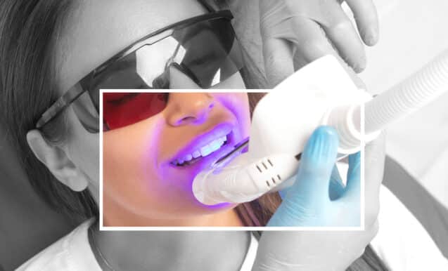 Will Smoking After Teeth Whitening Stain Teeth?