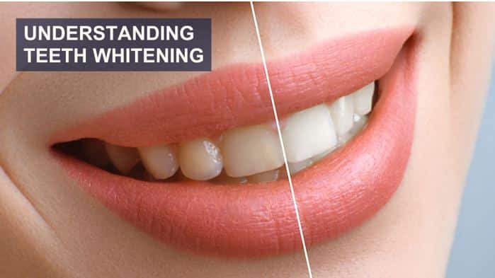 Teeth Whitening The Basics