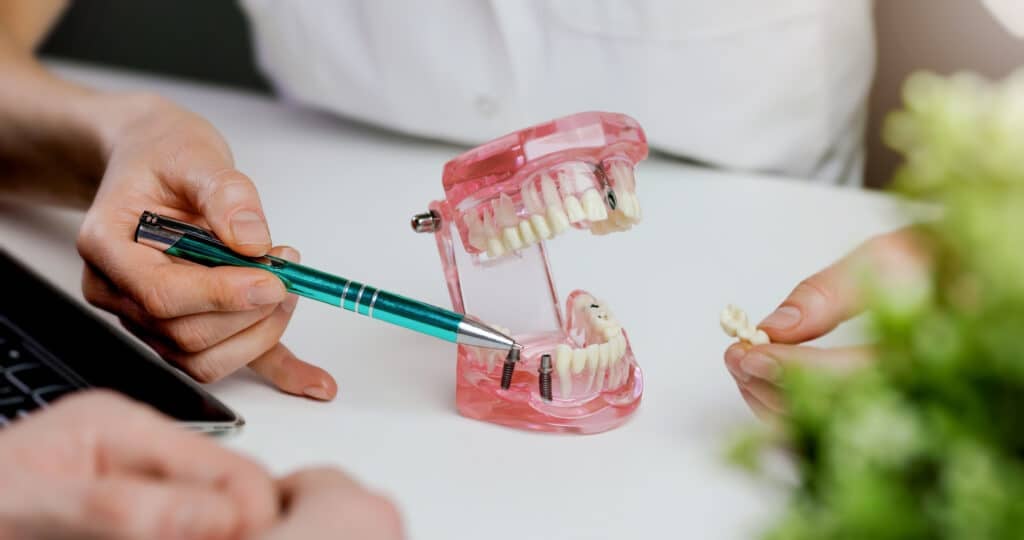 Dental Implants